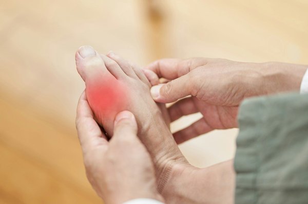 How can UK rheumatologists manage gout without long-term medication dependency?